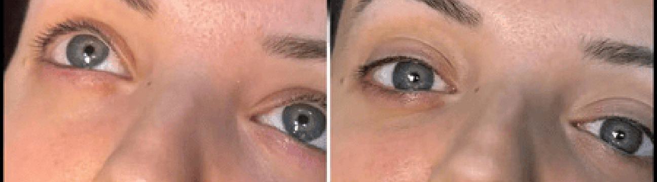 Dermal Fillers